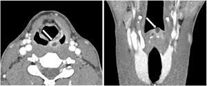 Axial and coronal post-contrast CT images at the time of second hospitalization show reduction of the aryepiglottic fold thickening, more evident on the right, with persistent enhancement on the left. A better-defined cystic lesion with peripheral enhancement is now seen along the inferomedial aspect of the left aryepiglottic fold (arrows).