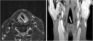 Axial T2-weighted fat-suppressed and coronal post-contrast T1-weighted MR images performed during the second hospitalization demonstrate marked reduction of the inflammatory changes in the aryepiglottic folds, with persistence of a small cystic lesion along the left aryepiglottic fold, without associated inflammatory signs (arrows).