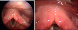 Nasofibrolaryngoscopy after 10-days and telelaryngoscopy after 1-month. No changes were observed in the posterior region of the larynx.
