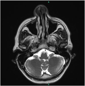 Axial T2-weighted MRI demonstrating a heterogeneous anterior nasal cavity lesion.