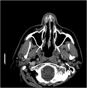 Axial section showing lesion with soft tissue density and areas of calcification.