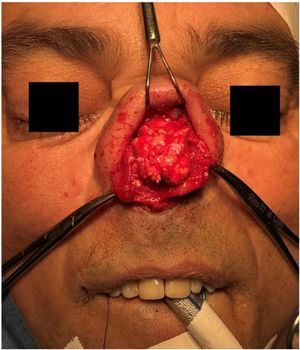 Open rhinoplasty.