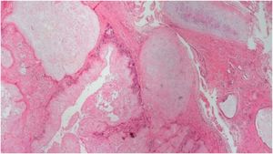 Histopathological examination showing nodular granulomatous aggregates of acellular, amorphous eosinophilic material surrounded by palisading histiocytes and multinucleated giant cells.