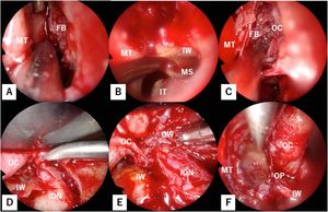 Stepwise view of the Double Silicone Procedure (DSP). Endoscopic examination through the left nasal cavity demonstrates removal of the uncinate process to expose the medial orbital wall fracture (A); resection of the maxillary sinus fontanelle subsequently opens the maxillary sinus (B); fractured bony fragments of the medial orbital wall are dissected from the orbital contents and removed (C); within the left orbit, the orbital contents are elevated from the fractured orbital floor, identifying the infraorbital nerve (D); tracing the superior margin of this nerve posteriorly identifies the inferior margin of the greater wing of the sphenoid bone (E); an endoscopic left-nasal view shows that lateralization of the orbital contents by the trans-orbital surgeon creates ample working space within the ethmoid sinus (F). FB, Fractured Bone; GW, Greater Wing of the sphenoid bone; ION, Infraorbital Nerve; IT, Inferior Turbinate; IW, Inferior Wall of the orbit; MT, Middle Turbinate; OC, Orbital Contents; OP, Orbital Process of palatine bone.