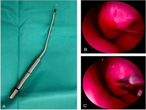 (A) Bipolar radiofrequency needle electrode (Aftmost, Inomed Ltd, Germany). (B) Injection of lidocaine into the inferior turbinate under endoscopic guidance. (C) Submucosal delivery of radiofrequency energy during the RFATR procedure.