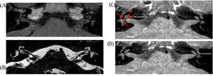 Temporal bone magnetic resonance imaging in axial sections. Source: Authors’ personal archive.