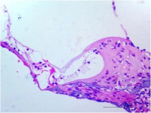 Group B – light microscope appearance of mild damage in the hair cells of the organ of Corti (H&E, ×100).