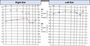 Audiometry demonstrating moderate conductive hearing loss in right ear.