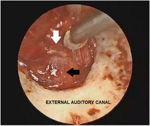 The endoscopic view: after the tympanomeatal flap was elevated, the grey dissector is softly separating the tumor (black narrow) to the tympanic membrane annulus (white narrow).