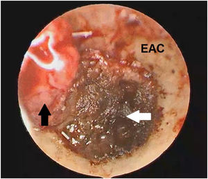 The endoscopic view: the black narrow shows an intact tympanic membrane instead the white narrow shows the tumor after the bipolar cautery is used to downsize the mass. EAC, External Auditory Canal.