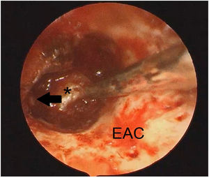 The endoscopic view: the middle ear space clear of disease after the mass was excised. The black narrow shows the stape superstructure. *, Promontory EAC, External Auditory Canal.