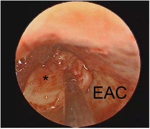 The endoscopic view: the middle ear reconstruction with tragus cartilage (*). EAC, External Auditory Canal.