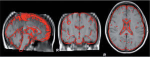 Herramienta FAST utilizada para segmentar la imagen obtenida por BET (brain extraction tool) en la sustancia gris neocortical, la sustancia blanca y el líquido cefalorraquídeo.