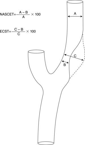 Medición de la estenosis carotídea extracraneal según NASCET y ECST.
