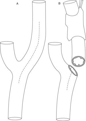 Endarterectomía clásica y endarterectomía por eversión. A: endarterectomía clásica con sección longitudinal a lo largo de la arteria carótida interna y la arteria carótida común. B: endarterectomía por eversión.
