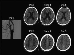 Angiografía por sustracción digital y tomografía computarizada sin contraste de un paciente con síndrome de hiperperfusión post angioplastia carotídea izquierda. La figura muestra la angiografía digital de un hombre de 65 años y las tomografías computarizadas de cerebro realizadas antes (PRE), a la hora y 5 días después de una angioplastia con stent en la arteria carótida interna izquierda. Obsérvese la estenosis carotídea izquierda y el edema hemisférico izquierdo en las tomografías hechas una hora y 5 días después de la angioplastia.