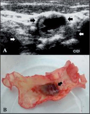 A: doppler color de vasos del cuello de placa ateromatosa en la arteria carótida interna derecha que evidencia hematoma intraplaca (flechas negras) y remodelación externa (flechas blancas). B: placa resecada mediante endarterectomía carotídea en la que se observa el hematoma recubierto por una muy adelgazada capa fibrosa, que ha sido retraída para una mejor visualización.