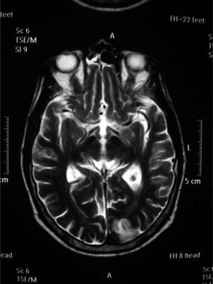 La RM craneal (corte axial en T2) muestra una imagen hiperintensa en el lóbulo occipital izquierdo compatible con lesión isquémica.