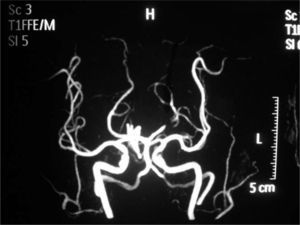 La angio-RM intracraneal muestra oclusión de la arteria cerebral posterior izquierda.