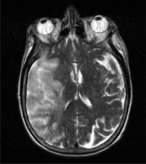 Resonancia magnética, secuencia T2. Se observa imagen hiperintensa en territorio de la arteria cerebral media derecha.