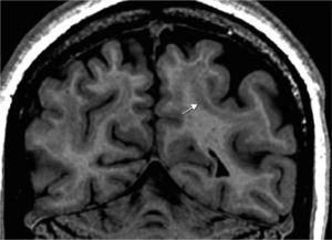 Adquisición 3D-T1 con reconstrucción coronal. Banda subcortical con señal muy similar a la corteza cerebral ubicada sobre la sustancia blanca de la región parieto-occipital izquierda (flecha). Una imagen similar se observa en el hemisferio contralateral.