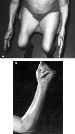 Debilidad y atrofia de cuádriceps y de los músculos flexores profundos de los dedos en pacientes con MCI.