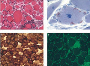 Hallazgos histológicos característicos en biopsias de pacientes con miositis por cuerpos de inclusión esporádica. A) Inflamación y vacuolas. Se observa inflamación endomisial, con linfocitos que invaden fibras musculares no necróticas de aspecto normal, y vacuolas red rimmed en 2 fibras musculares (flechas). B) Depósitos intracelulares de amiloide, fácilmente identificados con tinción de cristal violeta. C) Fibras citocromo-oxidasa (COX) negativas, indicativas de disfunción mitocondrial. D) Marcada expresión en todas las fibras del complejo mayor de histocompatibilidad clase 1 (verde) invadidas por células T o no.