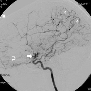 Angiografía por cateterismo de la arteria carótida interna izquierda intracraneal, proyección perfil.