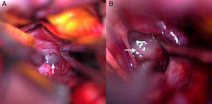 A y B. Biopsia quirúrgica. Se identifica masa grisácea de consistencia gelatinosa al nivel del espacio subaracnoideo en la cisterna silviana derecha, en situación supraselar (flechas).