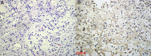 Histología de la lesión (H-E, x25). A. Tejido laxo fibrilar con células pequeñas redondas. B. En la inmunomarcación se constata proteína glio - fibrilar ácida (PGFA) positiva, lo que confirma la naturaleza neuroglial.