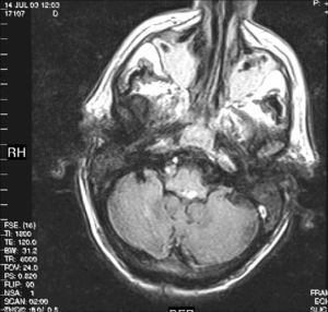 Resonancia magnética de un paciente de 70 años de edad que sufre una pérdida súbita de conciencia, seguida de apneas centrales y paro respiratorio. El flair muestra la presencia de un hematoma en la región dorsal del bulbo.
