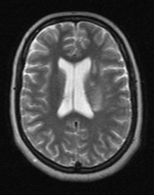RMN de cerebro, secuencia T2: lesiones hiperintensas que involucran el centro semioval, la corona radiada, el putamen y el núcleo caudado del lado izquierdo.