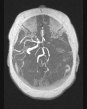 Angiorresonancia cerebral: ausencia de flujo a nivel de la arteria carótida interna, comunicante posterior y segmento proximal de la comunicante anterior del lado izquierdo con hiperflujo compensador del lado derecho.