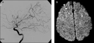 A. Angiografía por cateterismo de la arteria carótida interna (ACI) derecha, perfil. Estenosis de la porción terminal de ACI; estenosis y dilataciones multisegmentarias de las arterias cerebrales anterior (ACA), media (ACM) y posterior. Oclusión de múltiples ramas de ACA y ACM, con áreas avasculares. B. RM-DWI. Infartos recientes, corticales, en ambos lóbulos frontales.