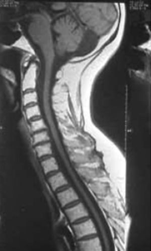 RM de médula cervicodorsal. Atrofia de médula dorsal que expresa la pérdida de los axones motores.