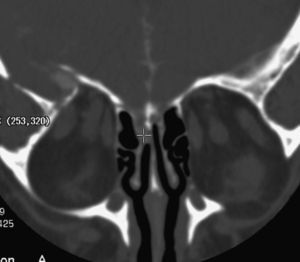 Cisterno-TAC craneal tras contraste yodado. Se evidencia una fístula de LCR al nivel de la lámina cribosa parasagital izquierda (cruz).