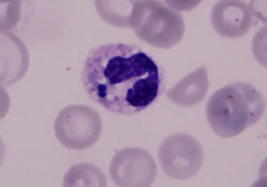 Tinción de Gram donde se evidencian diplococos gram positivos característicos de Streptococcus pneumoniae en el interior de un leucocito.