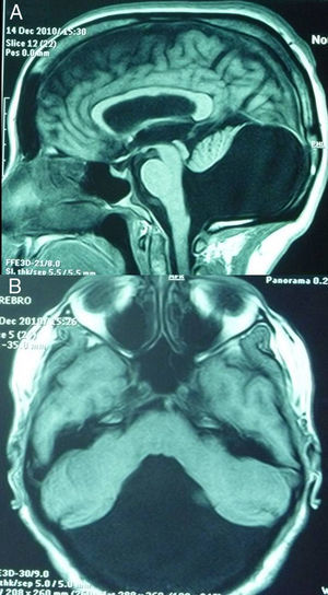 IRM en T1. A. corte sagital; el acueducto de Silvio se continúa con el IV ventrículo, que ocupa casi toda la fosa posterior. El cuerpo calloso, mesencéfalo, protuberancia y médula no tienen hipotrofia. B. Corte axial; hay ausencia del vermis e hipoplasia de los hemisferios cerebelosos, estos últimos abiertos en forma de alas y ubicados hacia delante.