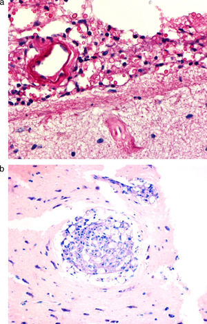 Granulomas con macrófagos en su interior, un hecho raro de observar en el diagnóstico inicial de criptococosis16.