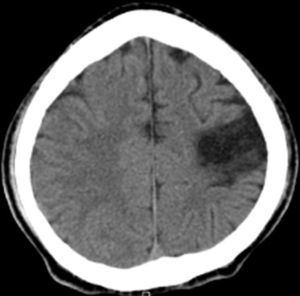 Tomografía de cráneo simple en la cual se observa infarto frontoparietal izquierdo.