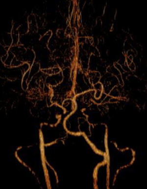 Angiotomografía en la cual podemos observar estenosis bilateral de ambas carótidas internas de predominio izquierdo, así como patrón arrosariado en la carótida derecha, característico de displasia fibromuscular. Se pueden observar también vasos de neoformación en las ramas distales del polígono de Willis.