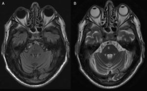 A nivel del tronco del encéfalo, en la protuberancia derecha se visualiza una imagen redondeada, hipointensa en Flair (A) e hiperintensa en T2 (B) correspondiente a lesión isquémica previa con signos de cavitación.