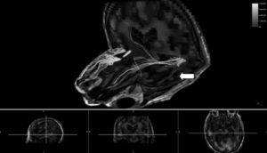 Neuroimágenes. Línea superior: fusión 3D de la imágenes de resonancia magnética morfológica (T1 3D) y tractografía con la imagen de perfusión cerebral con tomografía por emisión de fotón único (SPECT). Fascículo longitudinal inferior (FLI) izquierdo (flecha), las líneas opuestas muestran la diferencia con el FLI derecho (FLID). Se observa disminución significativa en el número de fibras que integran el FLII. Línea inferior: fusión de imágenes (sagital, coronal y axial) de la MRI (T1 3D) y perfusión cerebral con SPECT. Las imágenes descritas evidencian alteración funcional a nivel del lóbulo temporal izquierdo, tanto en las fibras de conducción como en la actividad metabólica de mucha mayor magnitud que lo observado en las imágenes estructurales clásicas.