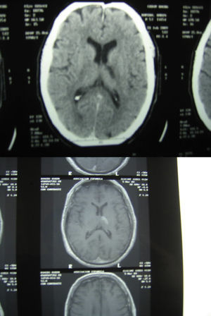 Caso número 4. Se observa a la izquierda la imagen tomográfica del infarto de arteria coroidea anterior izquierda, y abajo la imagen de resonancia magnética del mismo paciente.