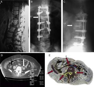 Imaging studies and anatomical correlation. (A) MRI (sagittal T1-weighted image). Metastatic lesions in vertebrae D11, L5 and S1. L1 vertebral body collapse and conus medullaris/cauda equina compression. (B and C) Post-surgical AP and lateral plain radiograph of the lumbar spine. Note instrumentation technique. (D) Axial computed tomography image without contrast. Note the lower density of paraspinal muscles (−35.2HU and −33.6HU), and left psoas muscle markedly hypotrophic (arrow). (E) Anatomical correlation at similar CT level (1) Crista iliaca, (2) Arteria iliaca comunis, (3) Nervus femoralis, (4) Nervi dorsal rami.