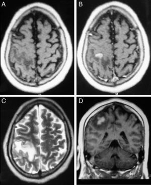 IRM preoperatoria. A. T1 sin contraste; B. T1 con contraste donde se evidencia lesión poscentral derecha lobulada con edema perilesional y realce homogeneo; C. T2; D. T1 con contraste.