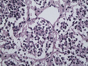 Corte histológico en hematoxilina-eosina, ×10. Se observa neoplasia vascularizada constituida por células epitelioides de núcleos redondeados de cromatina abierta (en «sal y pimienta») y citoplasma eosinófilo bien delimitado. Las células se disponen en grupos redondeados delimitados por septos vascularizados, estructura conocida como Zellballen.
