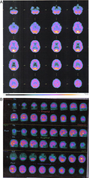 A y B. SPECT cerebral de 2 de los pacientes que integran la muestra.
