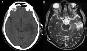 Imágenes postquirúrgicas correspondientes al caso 5. A. TC craneal: hipodensidad temporo-occipital izquierda residual. B. RM craneal secuencia T2 axial: lesión hiperintensa temporal izquierda.