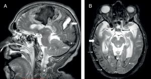 RM. A) Secuencia T2, plano sagital. Hemorragias lobares múltiples en el hemisferio cerebral derecho en diferentes estadios evolutivos: frontal aguda (desoxihemoglobina, flecha delgada), parietal subaguda (metahemoglobina, flecha gruesa) y occipital crónica (hemosiderina, flecha de puntos). B) Secuencia GRE, plano axial. Hemorragia lobar crónica en el lóbulo temporal derecho (flecha gruesa) y hemosiderosis superficial (flechas delgadas) en los lóbulos temporal y occipital derechos. Hemorragia aguda en las astas occipitales de los ventrículos laterales (flechas de puntos).
